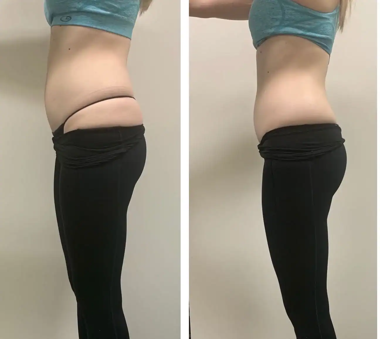 Stomach before and after: 26 years · one session, 1 inch lost
