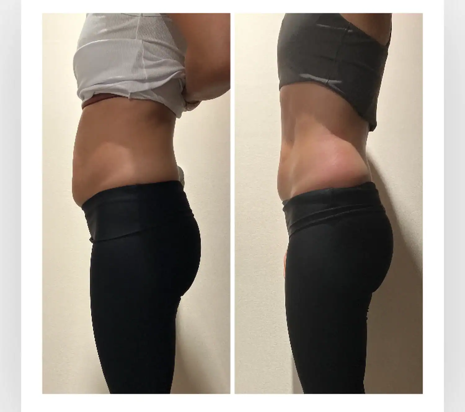 Stomach before and after: 36 years · one 45-min session, 1.5 inches gone