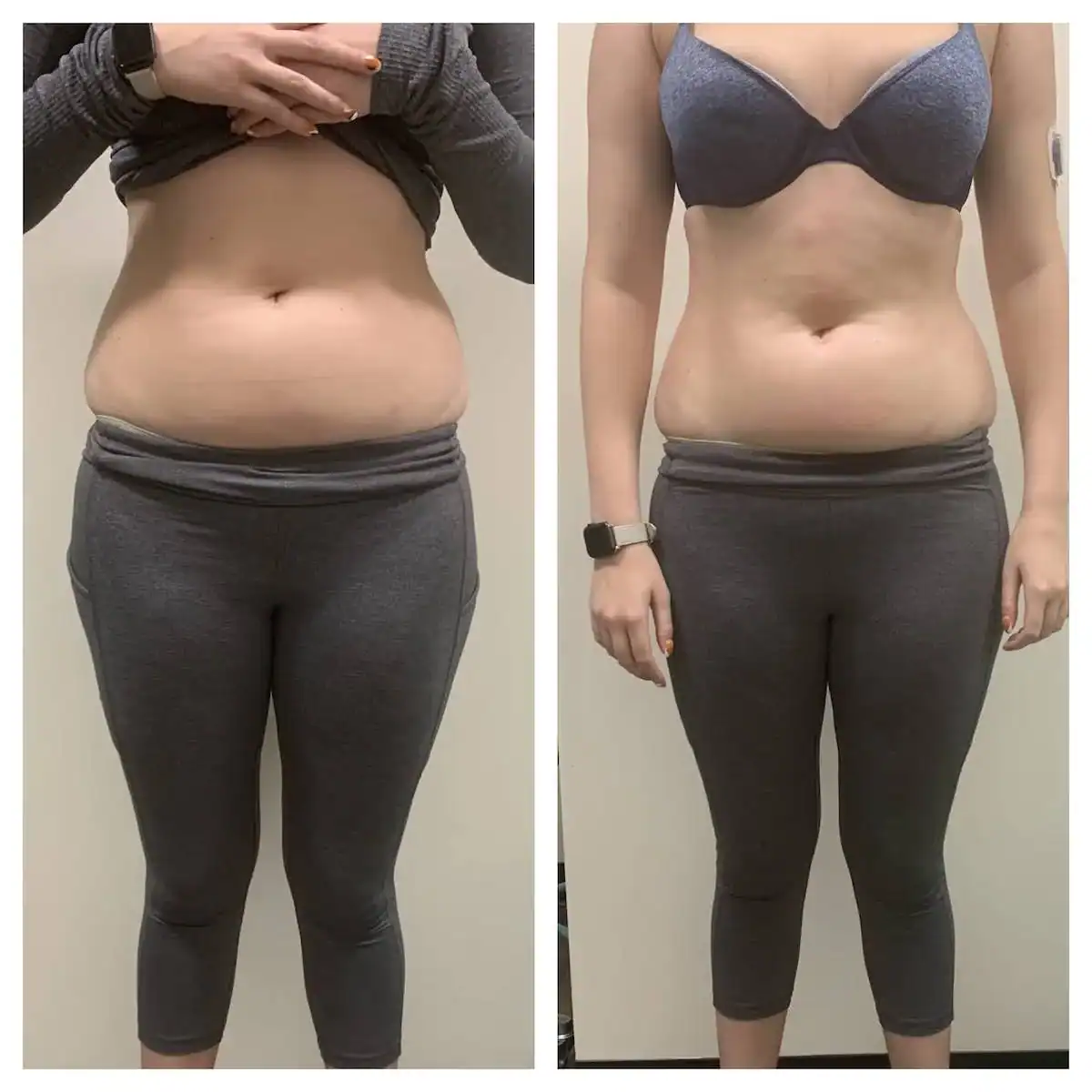 Stomach before and after: 39 years · one session, 1 inch lost