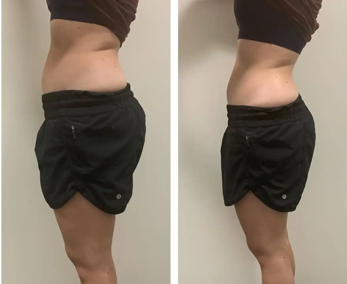 Stomach before and after: 30 years · one session, 1 inch lost