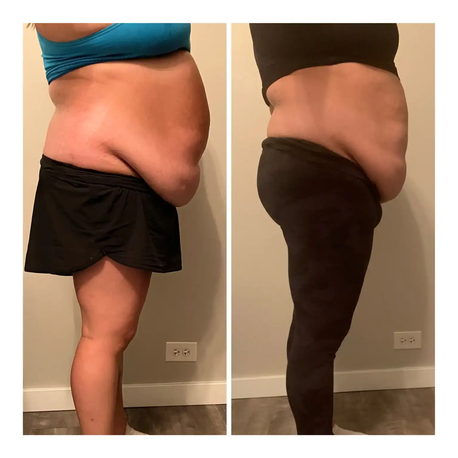Stomach before and after: 33 years · four 90-min sessions, 5 inches lost