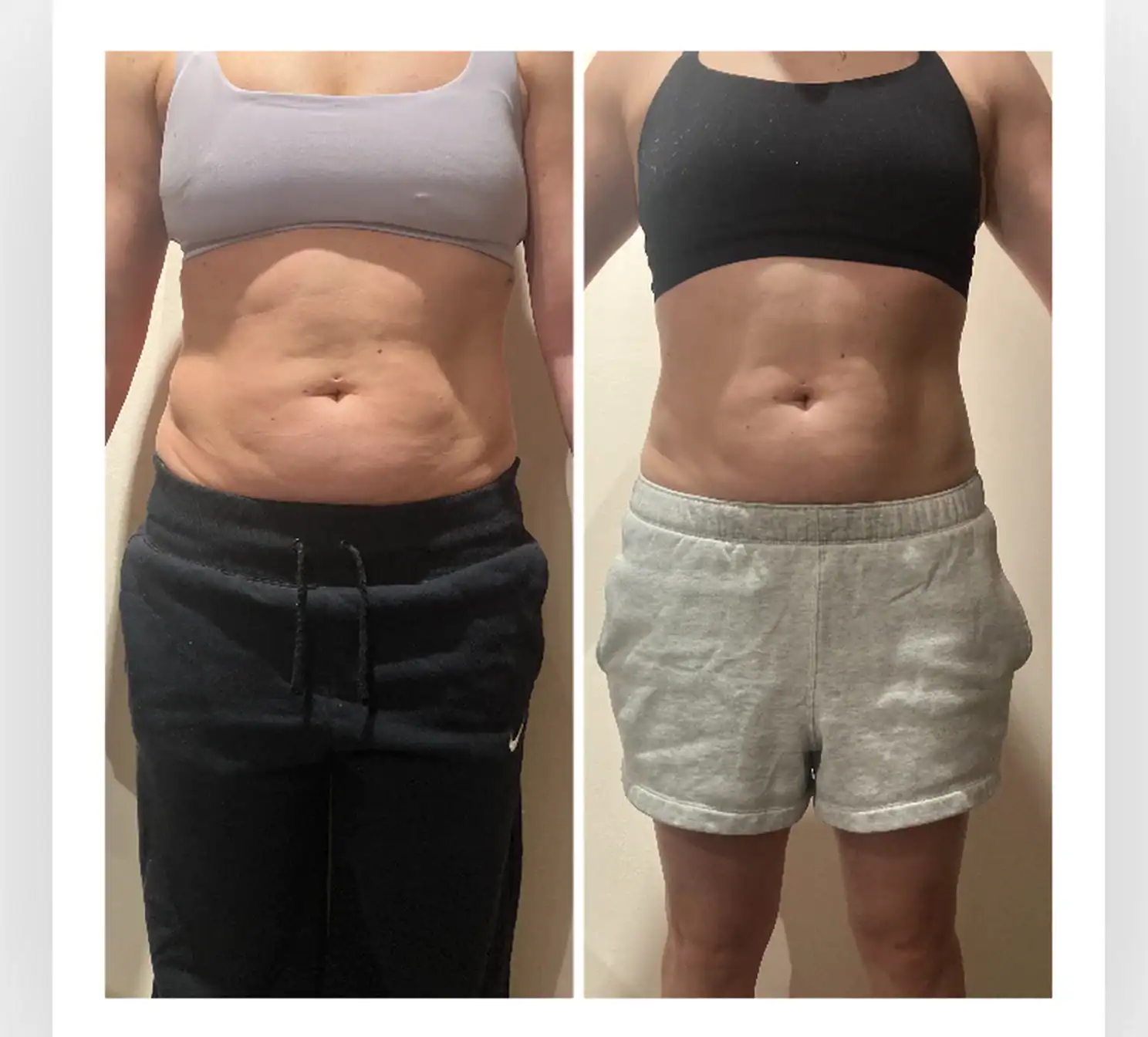 Stomach before and after: 40 years · two sessions, 1.5 inches lost