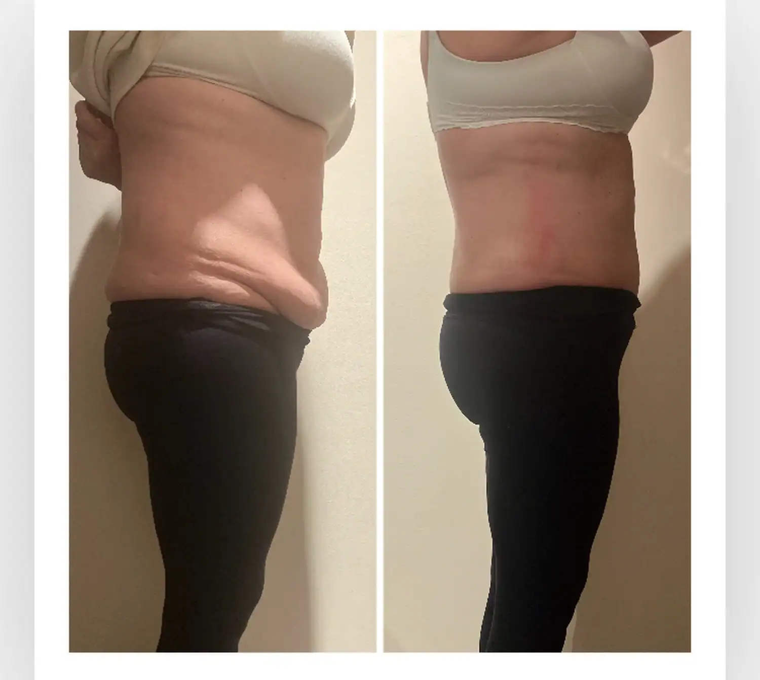 Stomach before and after: 58 years · three sessions, 3 inches gone