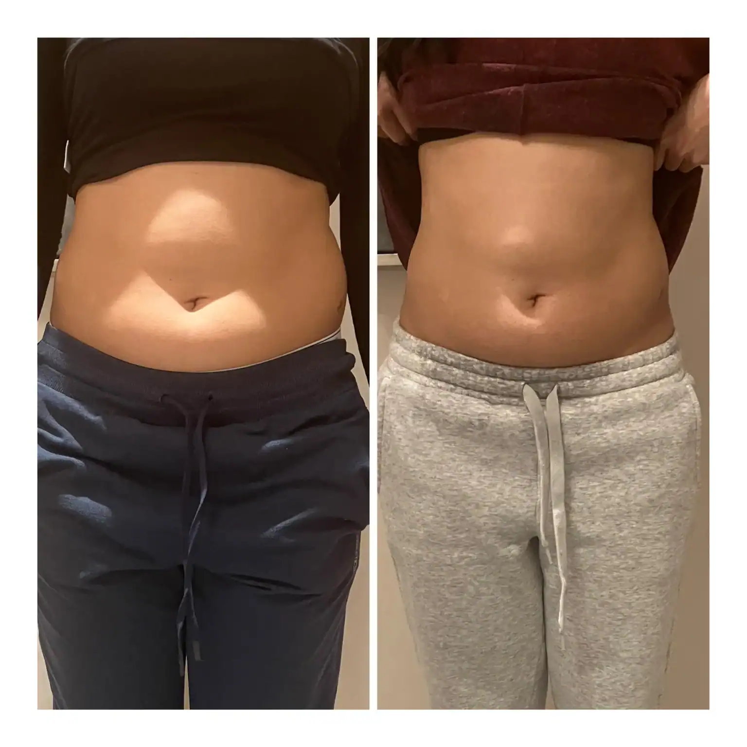 Stomach before and after: 24 years · three sessions, 3 inches lost