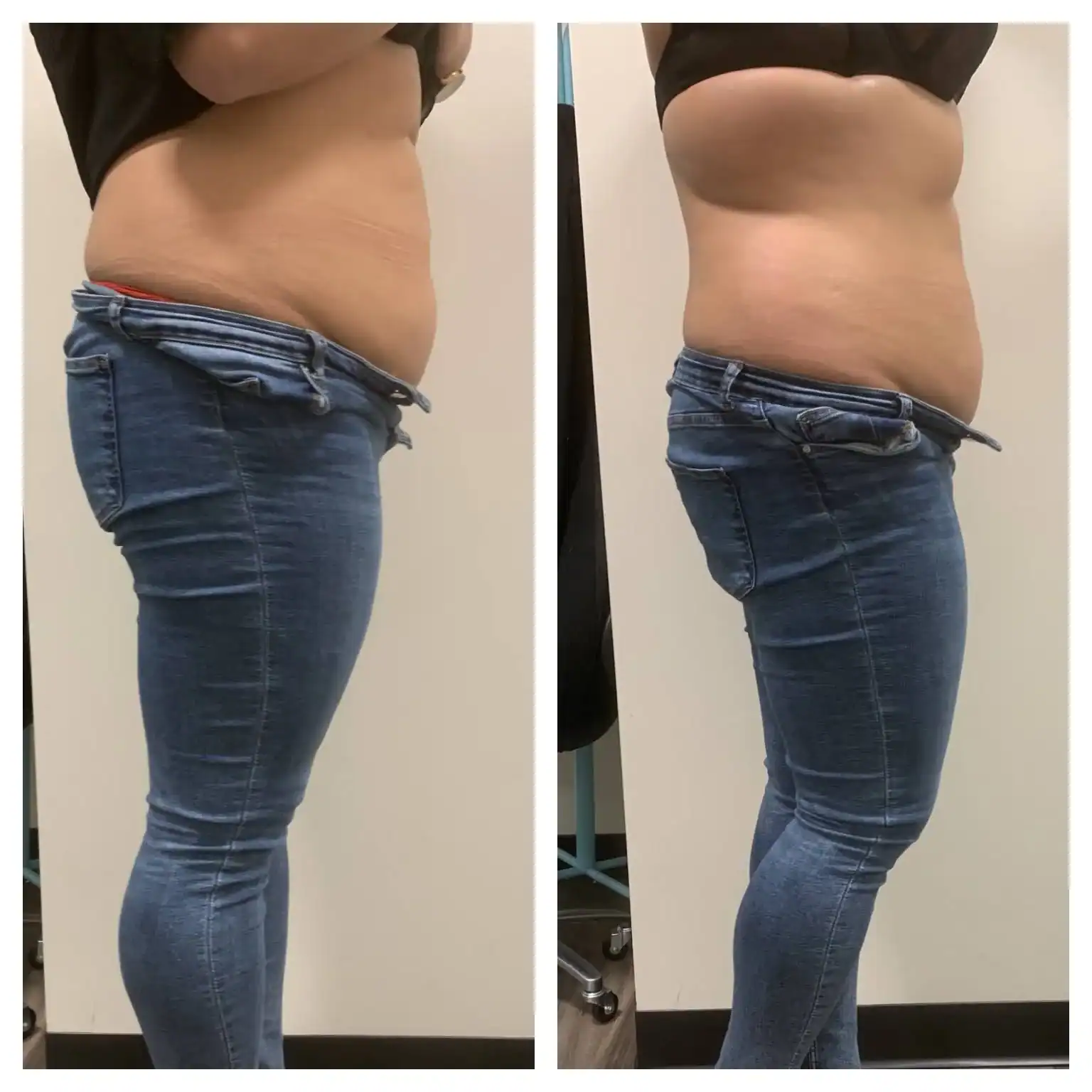 Stomach before and after: One 90-min session, 1.5 inches lost