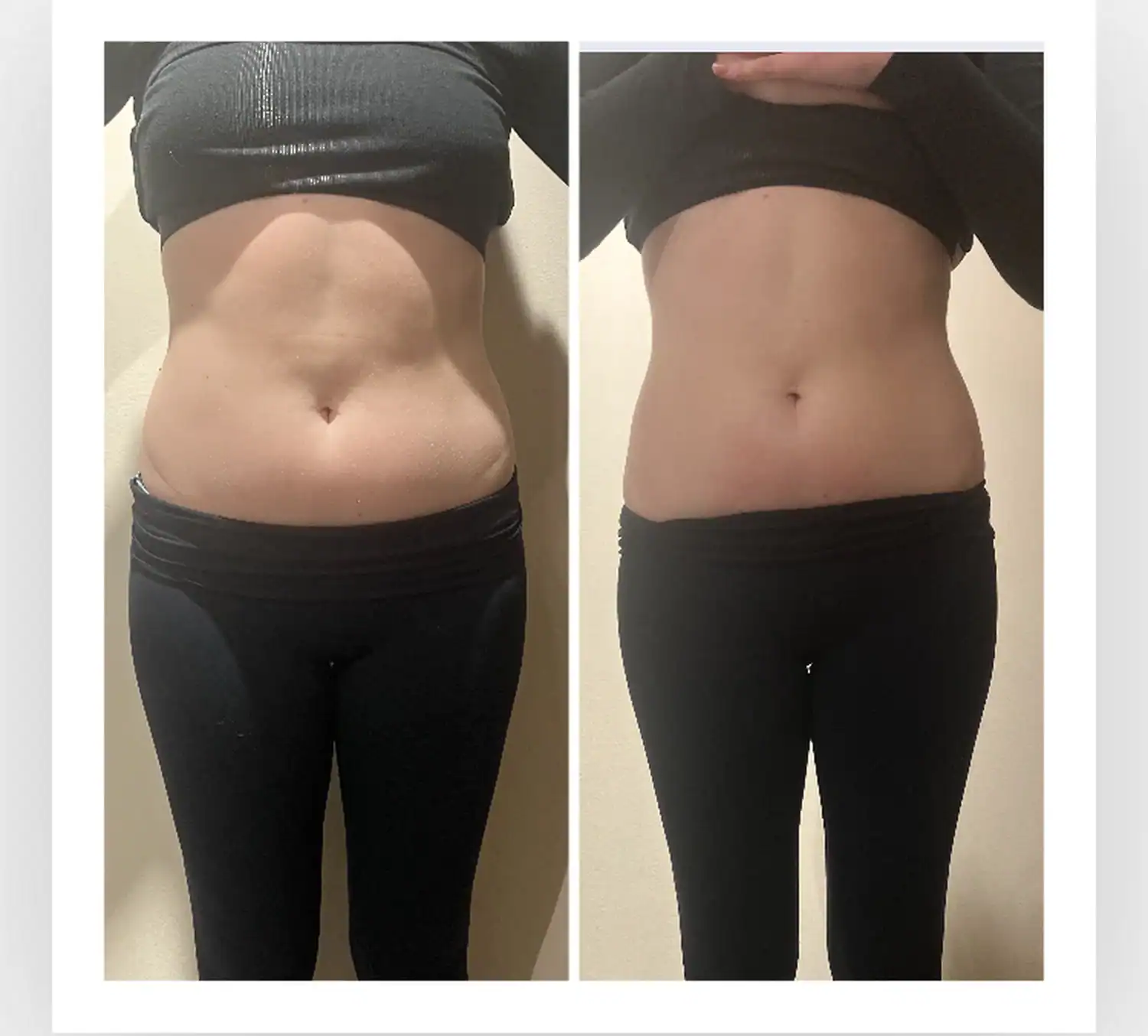 Stomach before and after: 32 years · one session, 1 inch lost