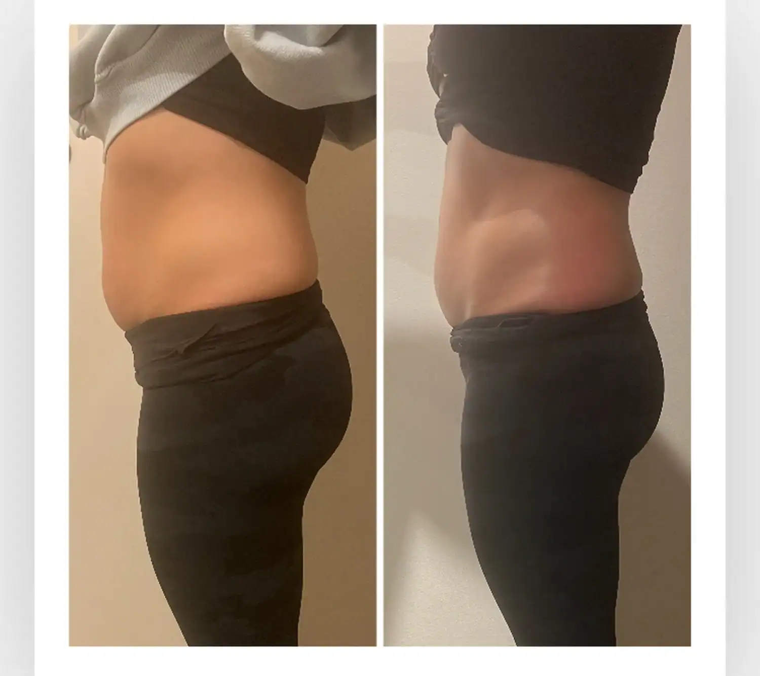 Stomach before and after: 37 years · one session, 1 inch lost