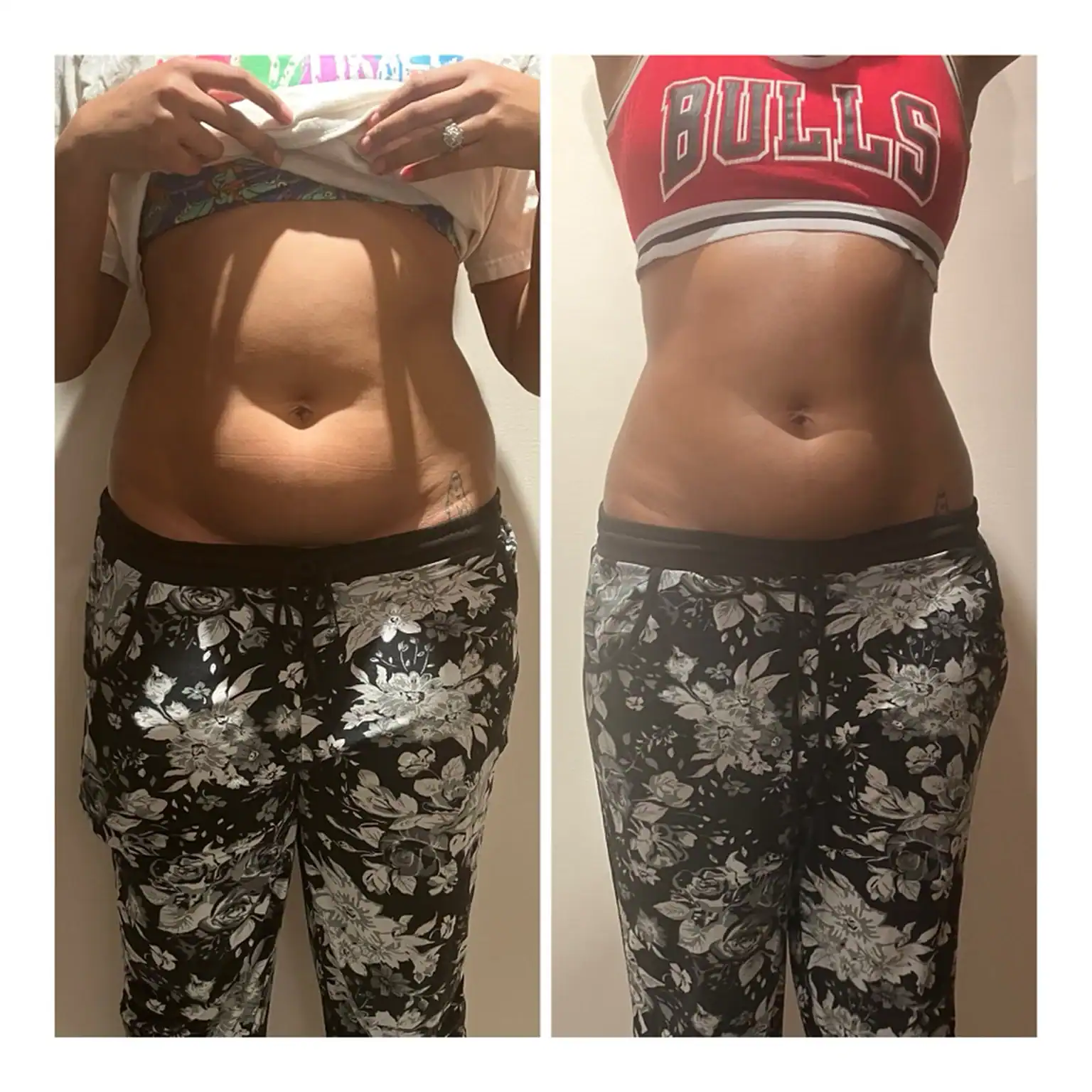Stomach before and after: 32 years · three sessions, 3 inches gone at waistline
