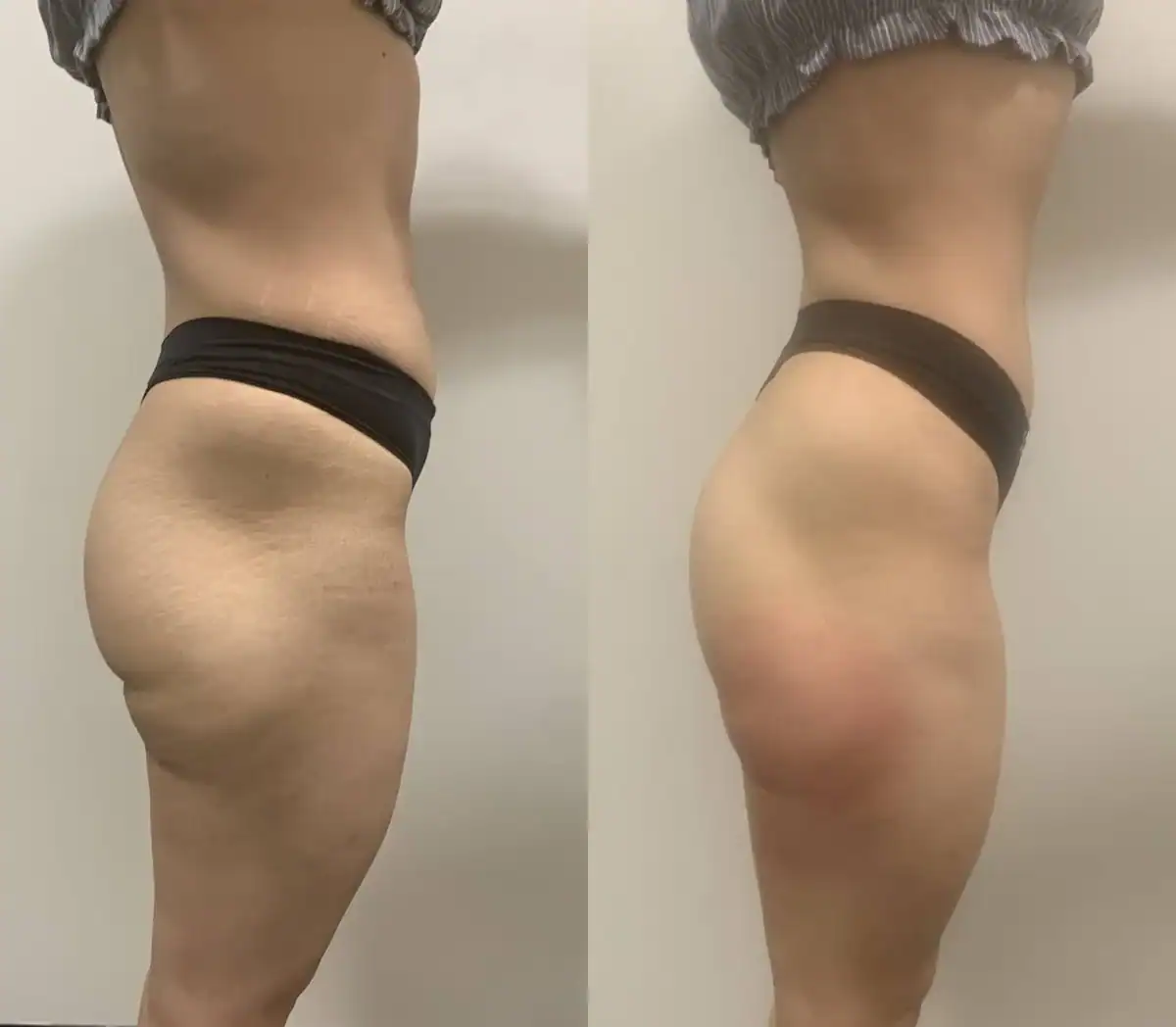 Thighs before and after: 26 years · five sessions, Cellulite reduction