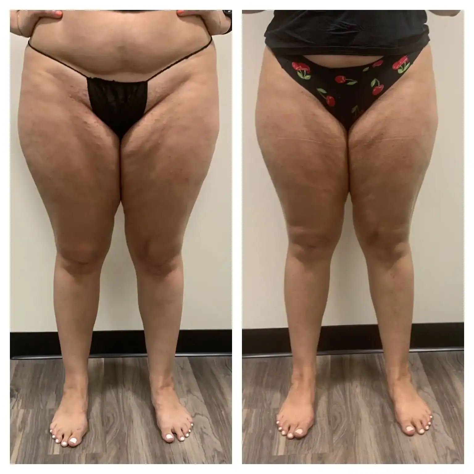 Thighs before and after: 26 years · five sessions, Cellulite treatment