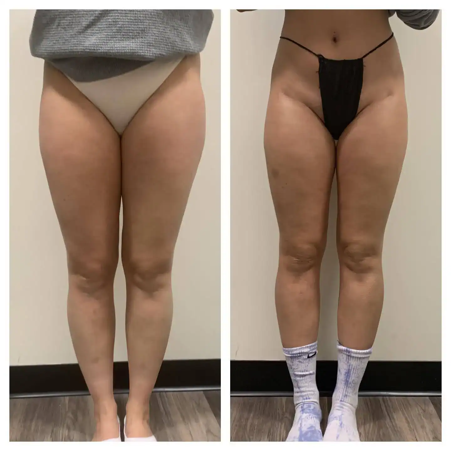 Thighs before and after: 34 years · five sessions, Inner thighs
