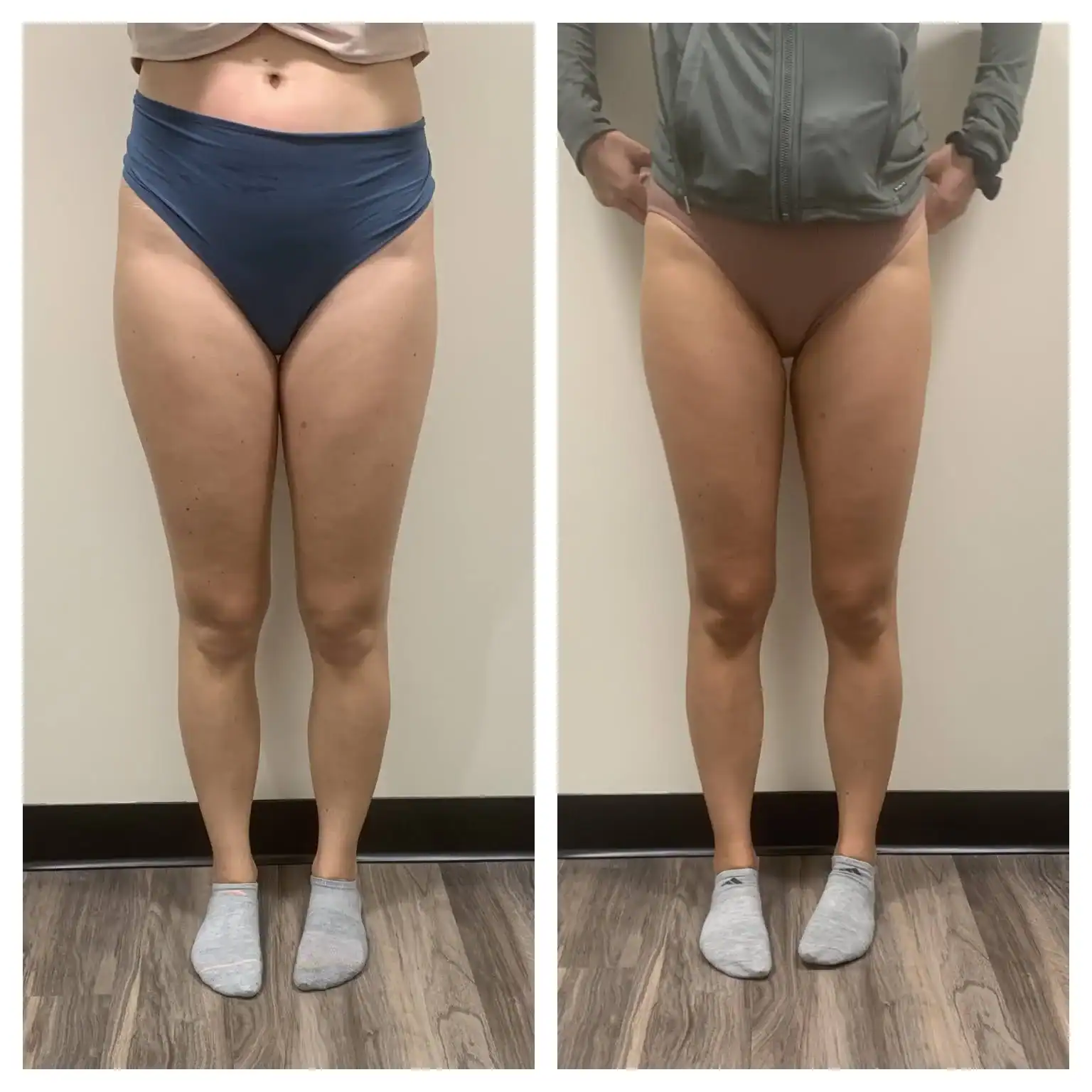 Thighs before and after: 35 years · four sessions, Inner thighs