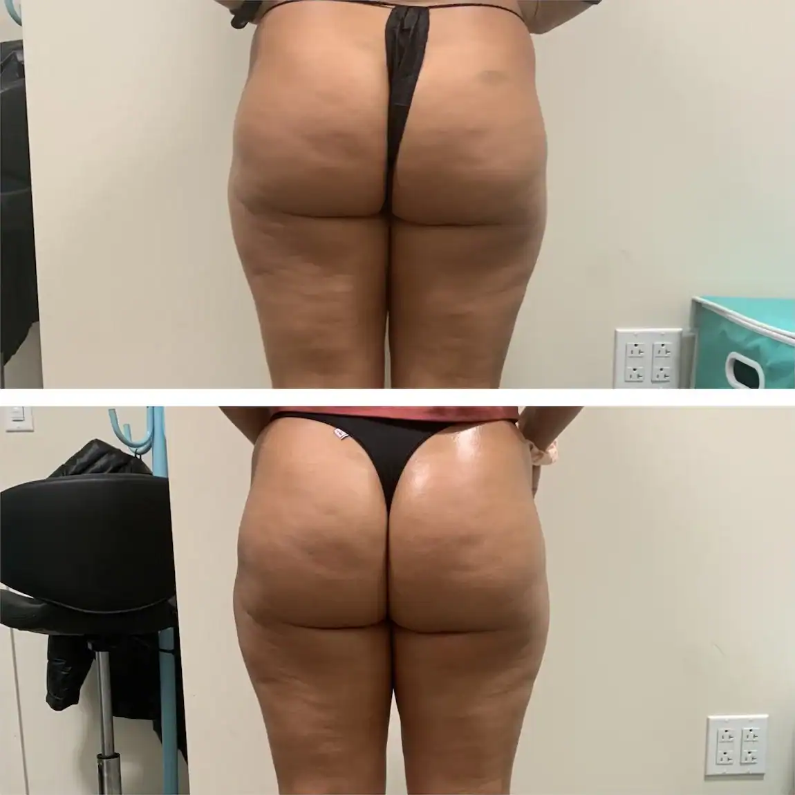 Thighs before and after: 45 years · five sessions, Cellulite treatment