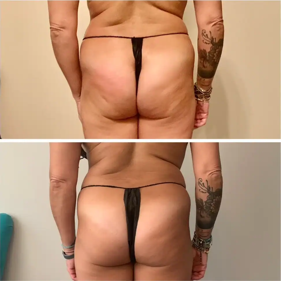 Thighs before and after: 50 years · five sessions, Cellulite, butt