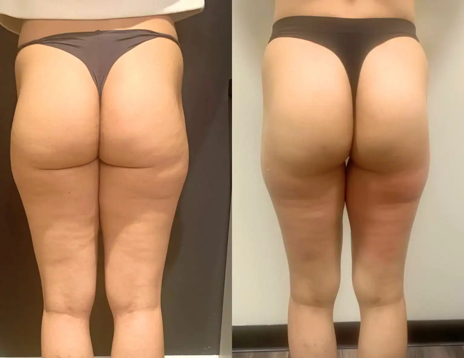Thighs before and after: 24 years · four sessions, Legs, cellulite