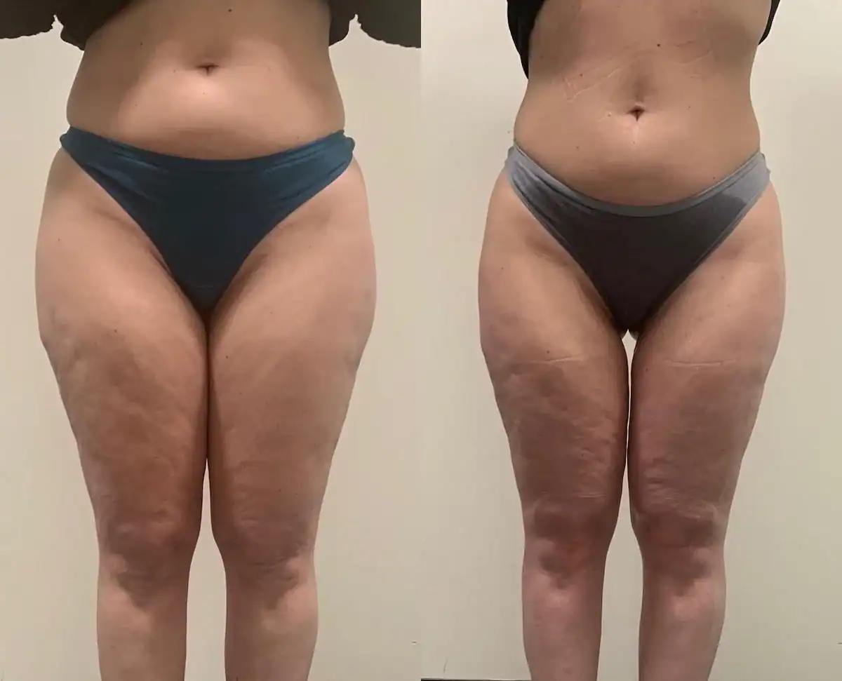 Thighs before and after: 52 years · five sessions, Cellulite treatment