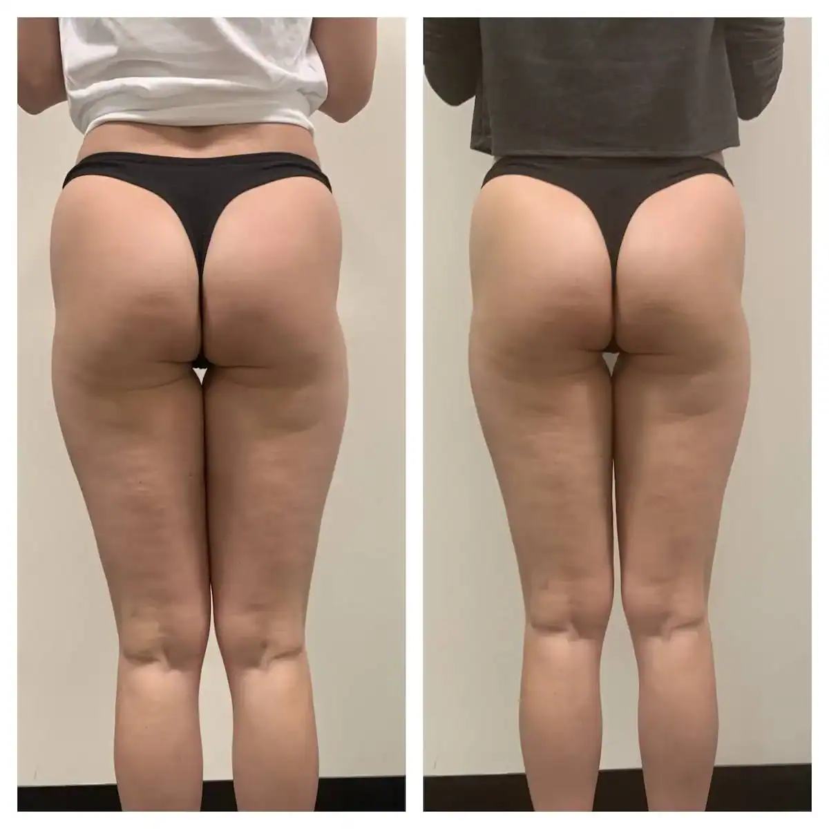 Thighs before and after: 27 years · four sessions, Thigh gap, cellulite