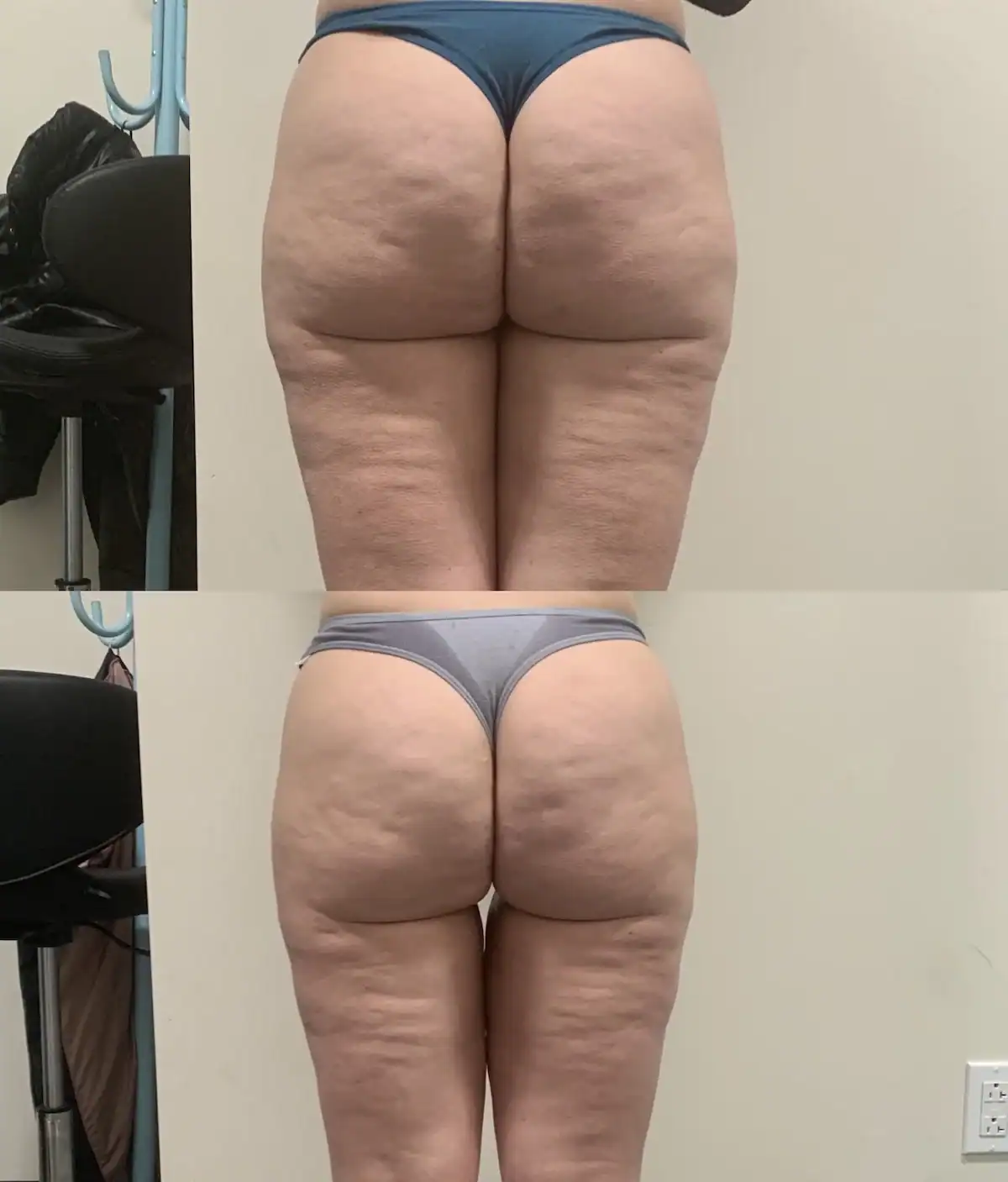 Thighs before and after: 50 years · ten sessions, Cellulite treatment