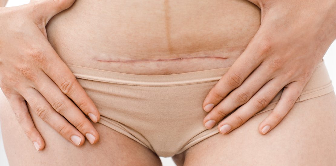 closeup of woman's belly with a scar from a cesarean section or surgery or operation