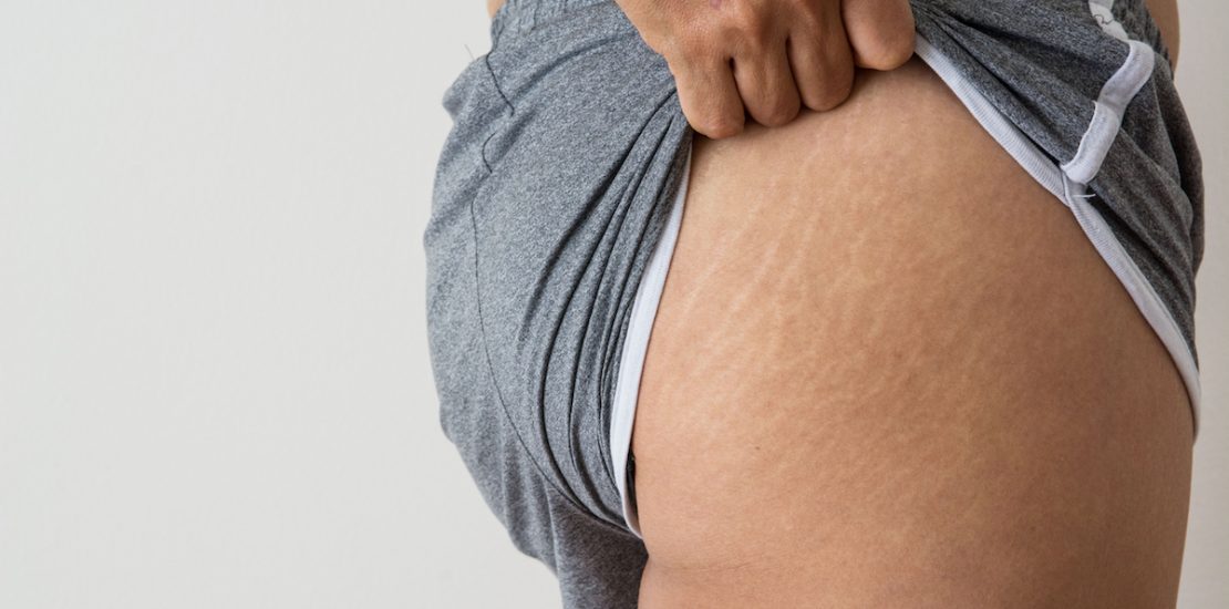 women fat belly fat with stretch marks on white background